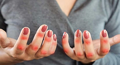 Lupus hastalığı nedir? Lupus hastalığı öldürür mü? Lupus tedavisi